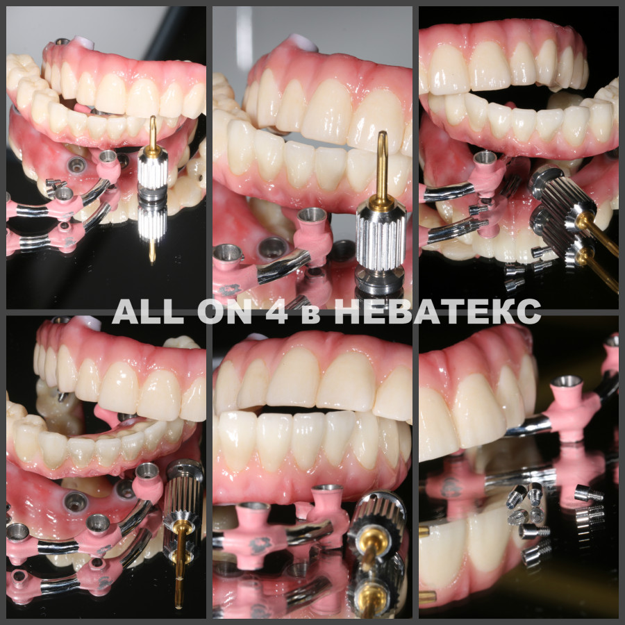 all on 4 фото постоянных протезов циркон