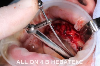 операция имплантация all on 4