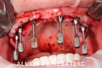 имплантация allon4