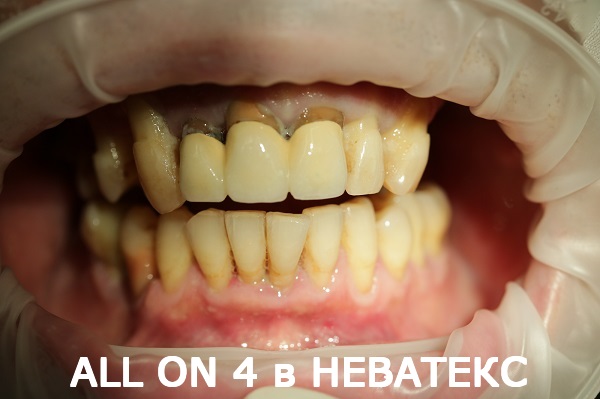 all on 4 фото до
