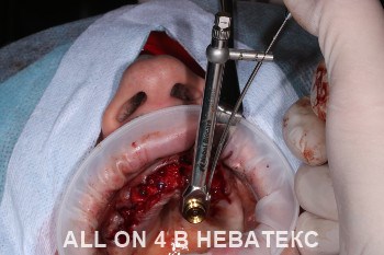 имплантация all-on-4