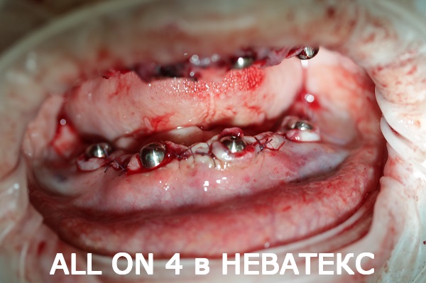 all on 4 фото во время имплантации