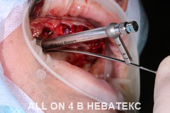 имплантация all-on-4 операция