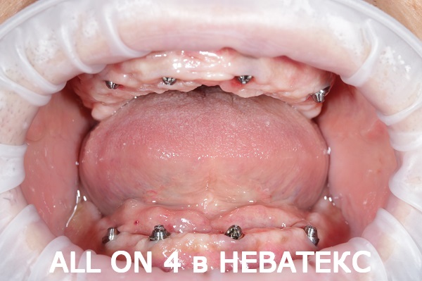 несъемные зубные протезы фото