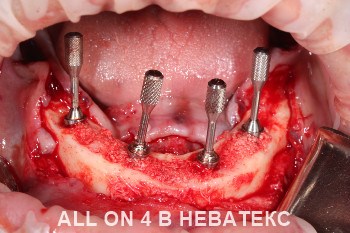 имплантация all-on-4 фото нижней челюсти
