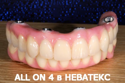 allon4 имплантация