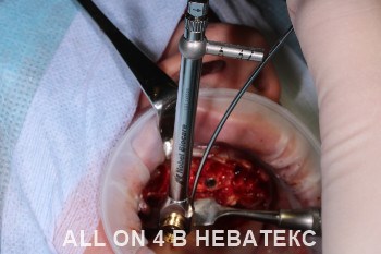 имплантация all-on-4 фото операции