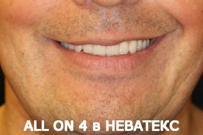 allon4 несъемные зубные протезы