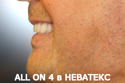 all on 4 несъемные протезы вид сбоку