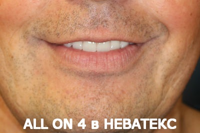 all on 4 вид спереди