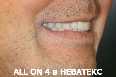 all on 4 фото после