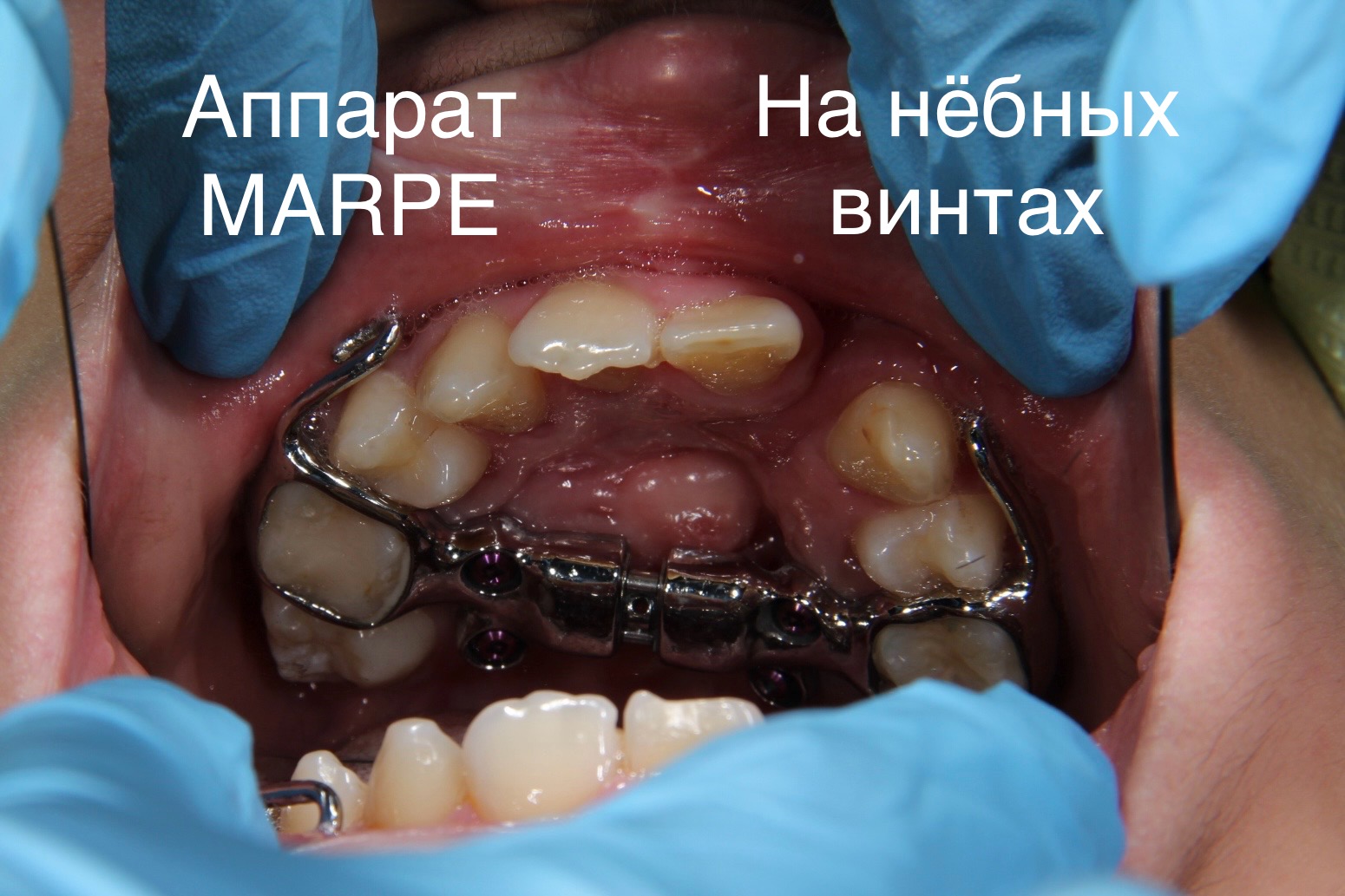 аппарат MARPE на небных винтах