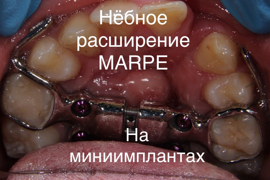 небное расширение MARPE