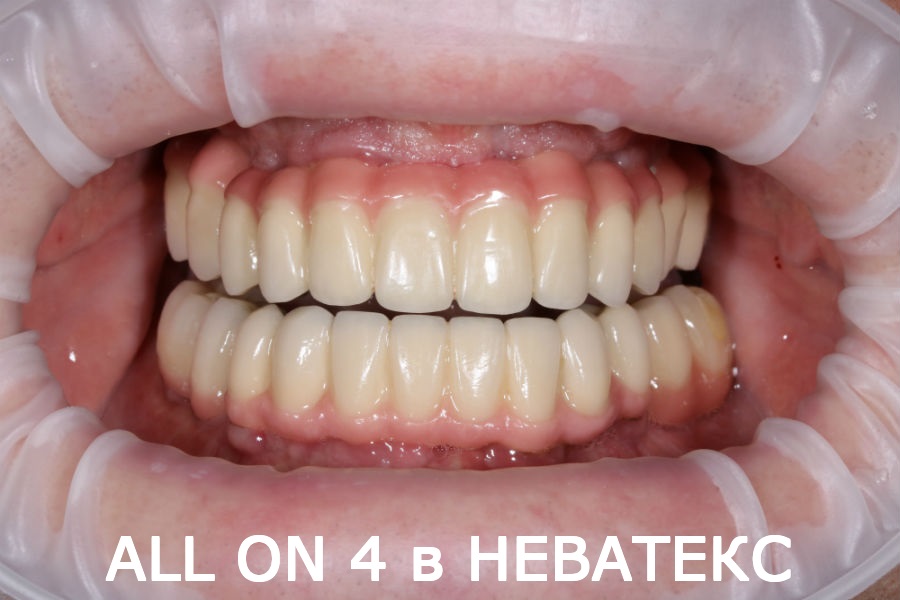 все зубы на шести имплантах