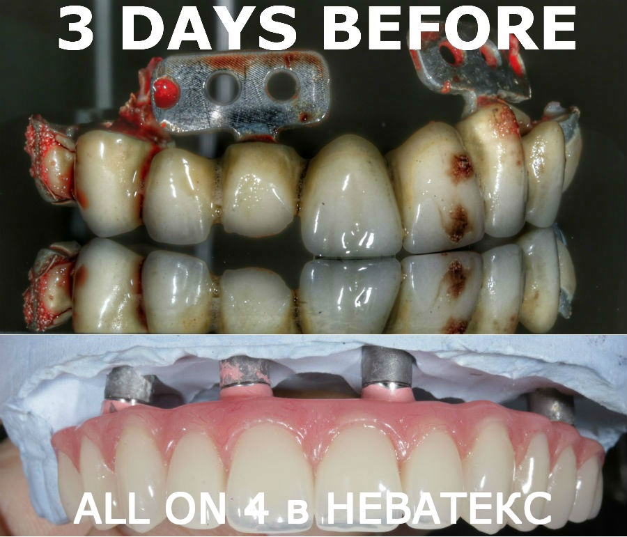 фото состояние челюсти до имплантации all on 4