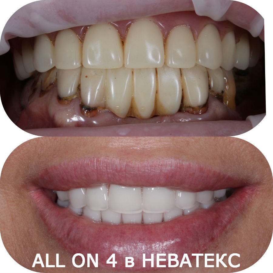 фото отзыв олл он фо до и после