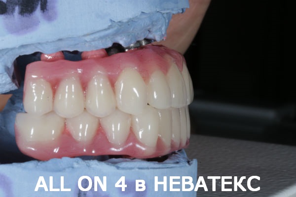 олл он фо протез вид сбоку