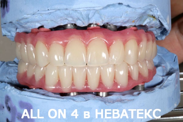 allon4 протезы вид спереди