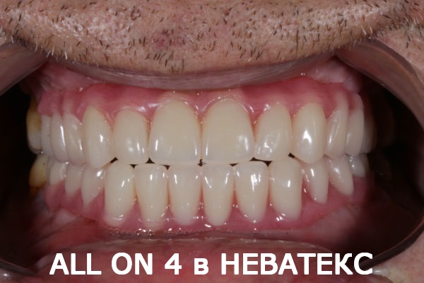 all on 4 фото после операции