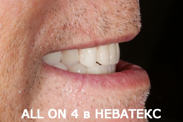 алонфо фото вид сбоку