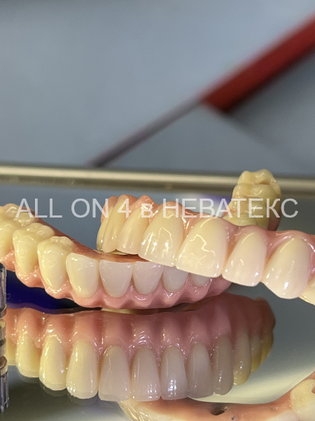 постоянные протезы all on 4
