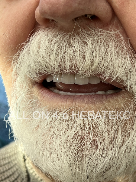 протезы all-on-4 предназначены для постоянного ношения