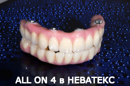 all on 4 фото несъемных протезов