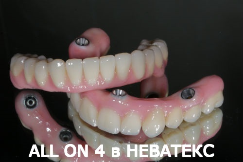 как выглядят протезы allon4