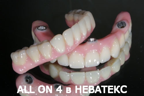 allon4 протезы верхняя и нижняя челюсти