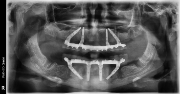 all on 4 имплантация рентгеновский снимок