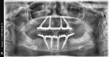 all on 4 имплантация рентген