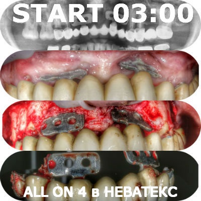 фото этапов операции all on 4