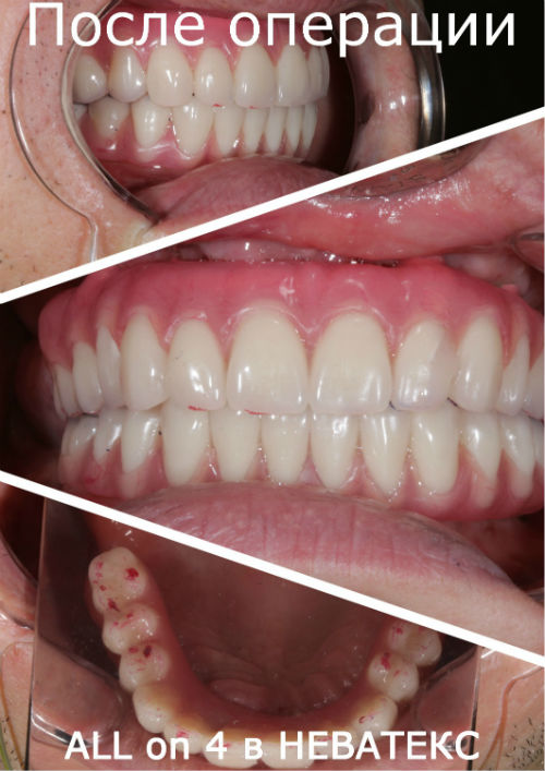 Фото после операции All on 4