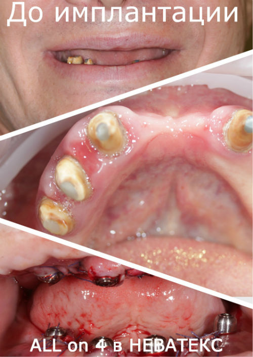 Фото до перации All on 4