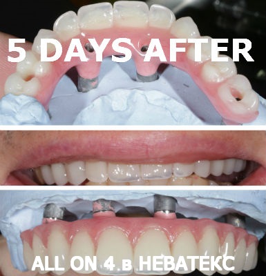 фото улыбка после имплантации алл он фо