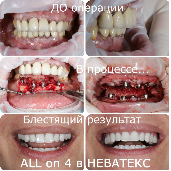 all on 4 до и после имплантации