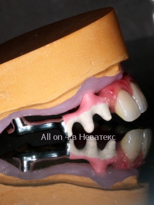 дуга-гребенка для протеза all on 4