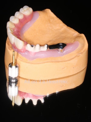 балка - основа керамокомпозитного протеза