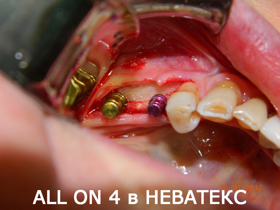 протез all on 4 фото