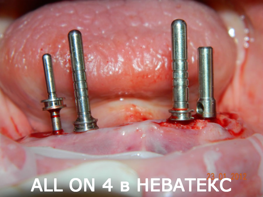 зубы за один день all on 4