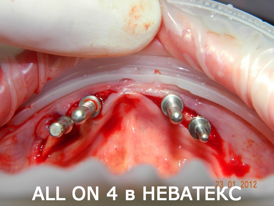 зубы за 1 день по техногии all on 4