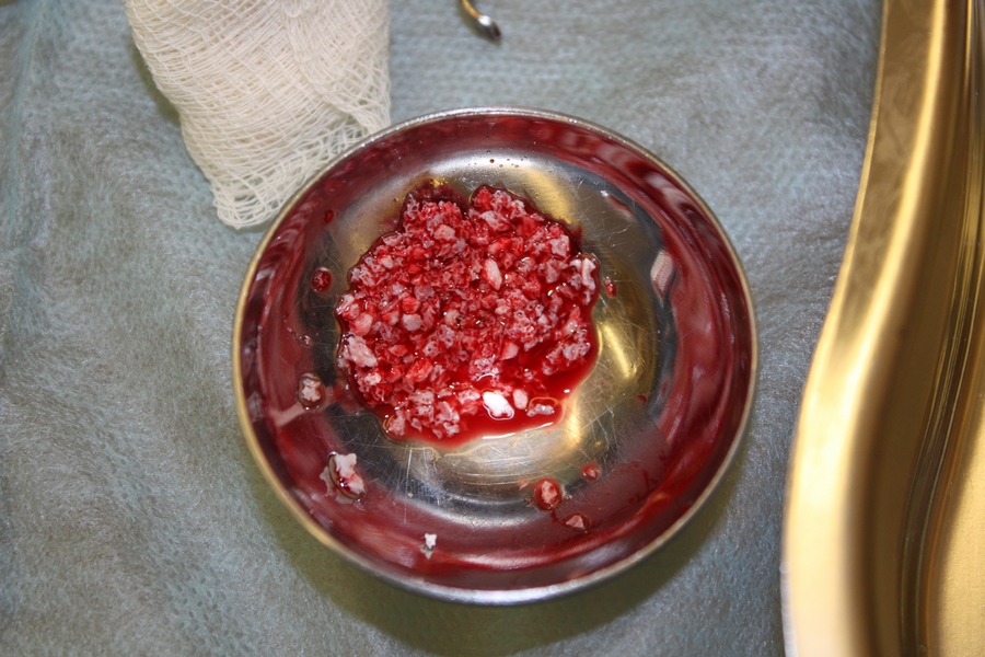 имплантация олл он фо