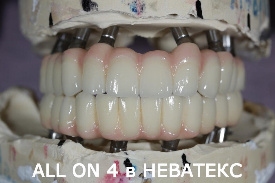 all on 6 неватекс