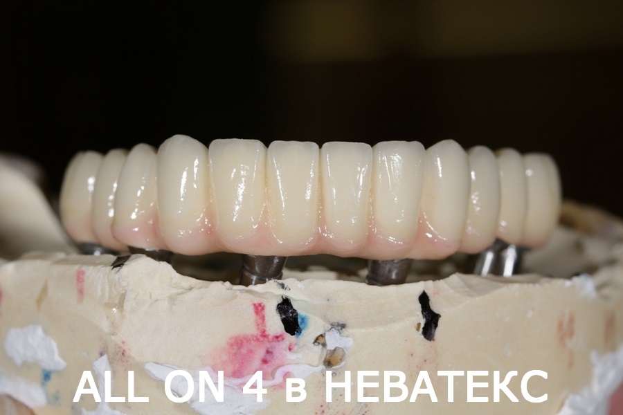 all on 6 имплантмен