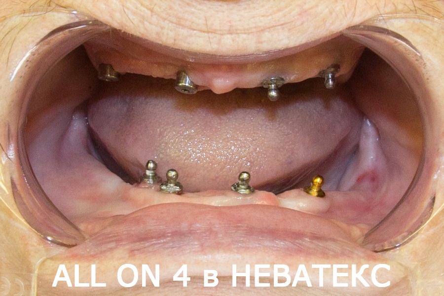 зубы за 1 день по технологии all фото