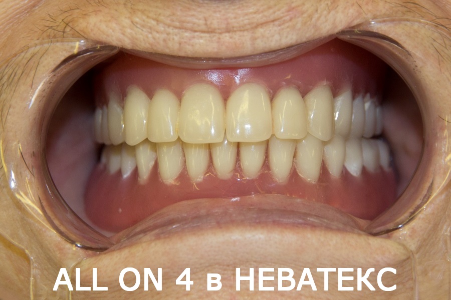 зубы за один день картинки