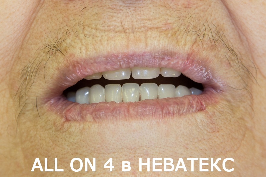 зубы за один день фото до и после