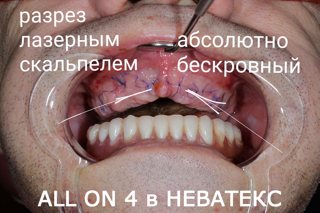 зубы на четырех имплантах