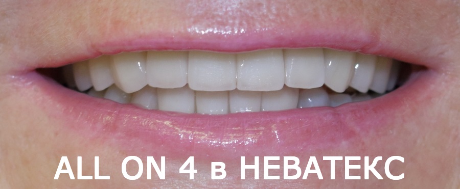 протезирование зубов на 4 имплантах стоимость фото до и после