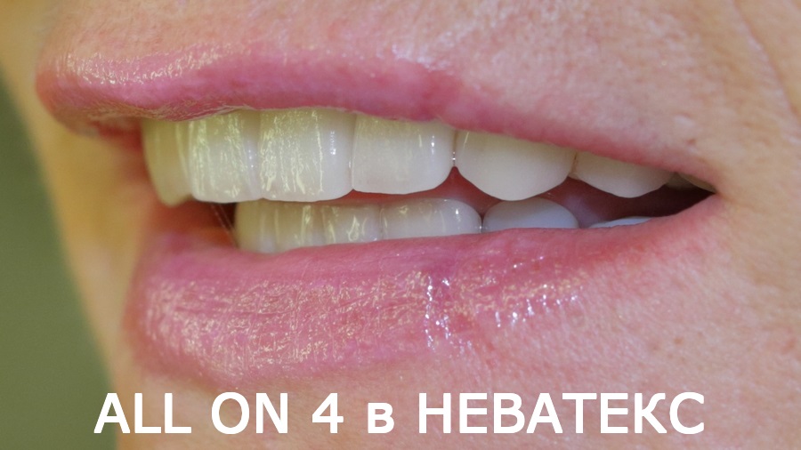 восстановление зубов имплантами all on 4